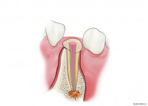 感染根管治療3　根管充填　